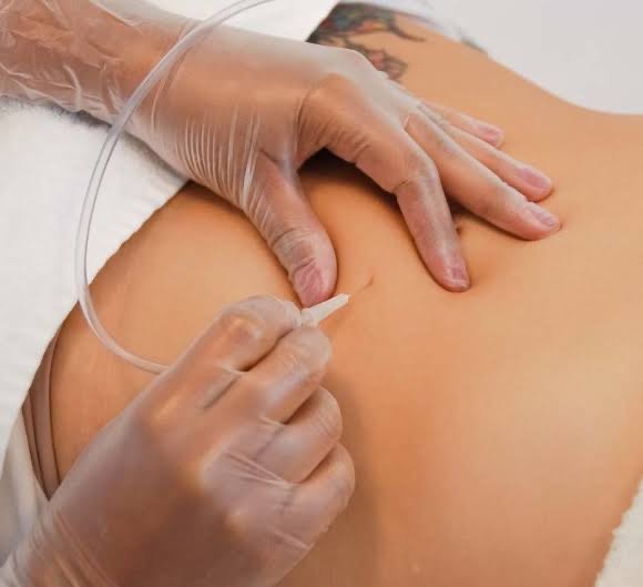 Carboxiterapia Corporal