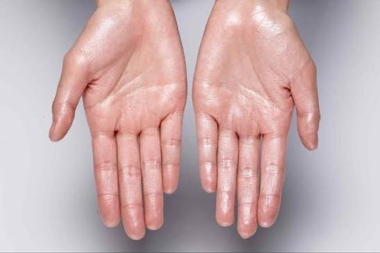 Hiperhidrosis